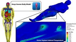 Wireless Transmitter MRI Compliance